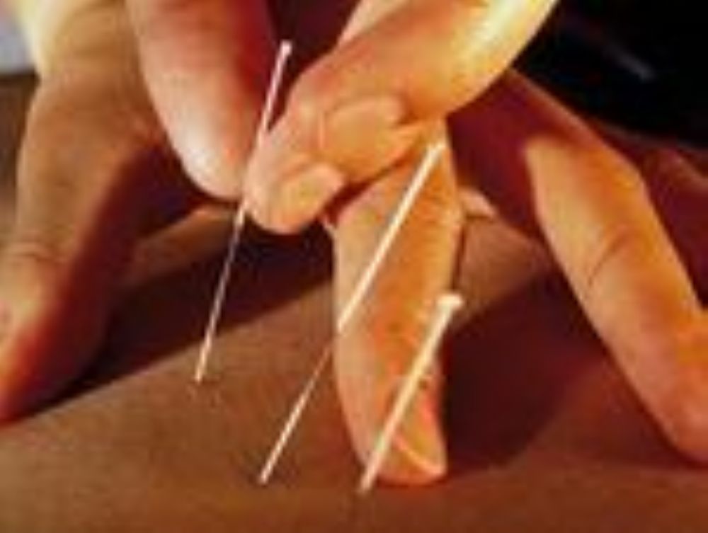    Acupuncture :